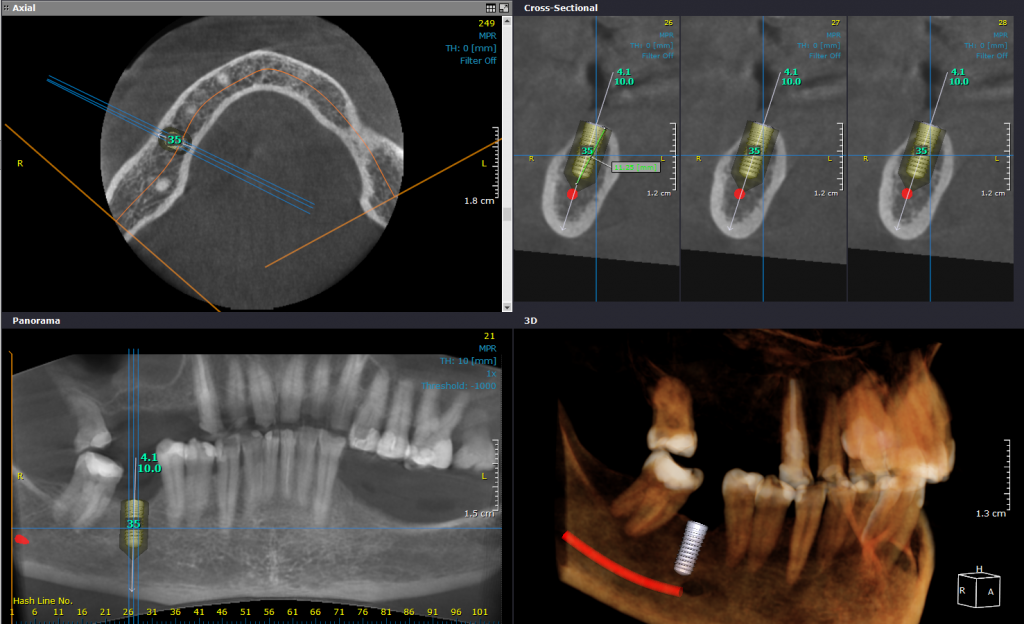 Implant planning CRANEX_3D_Nerve_canal_marking_for_implant_planning